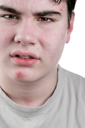 teenage acne